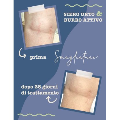 Stretch mark treatment