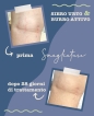 Stretch mark treatment